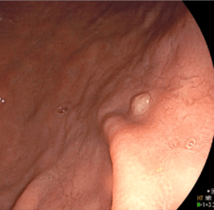 胃底腺ポリープ
