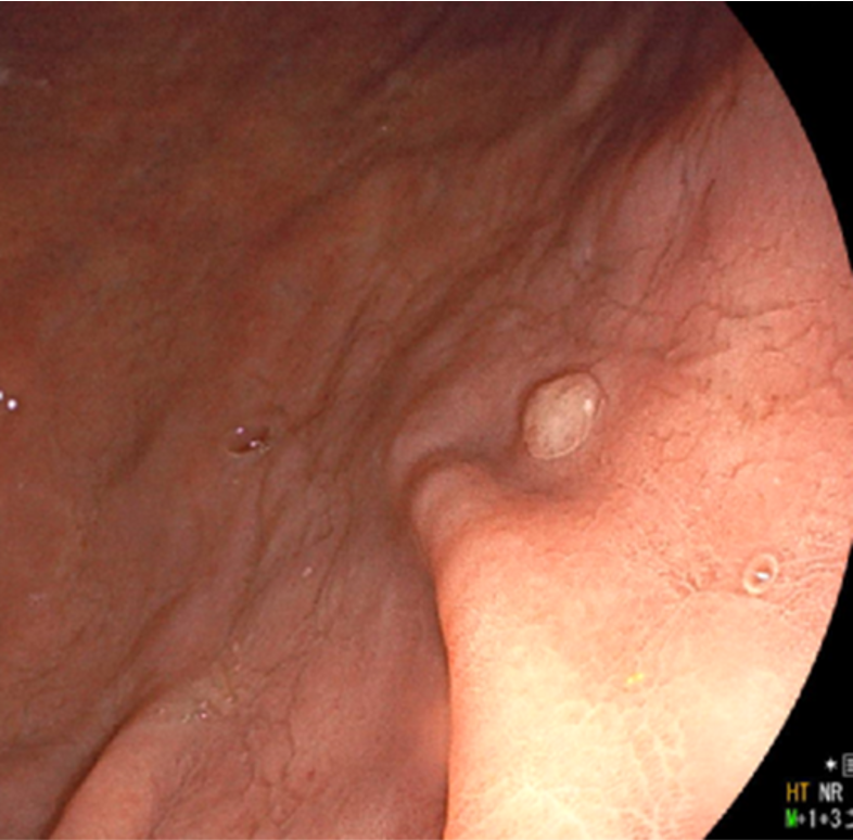 胃底腺ポリープ