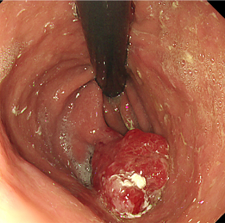 胃過形成性ポリープ